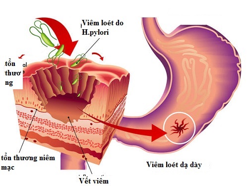 viem-loet-da-day-do-vi-khuan1