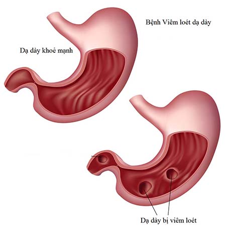 Viêm dạ dày – Nguyên nhân và triệu chứng