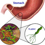 Điều trị và phòng ngừa Loét dạ dày tá tràng do H. pylori
