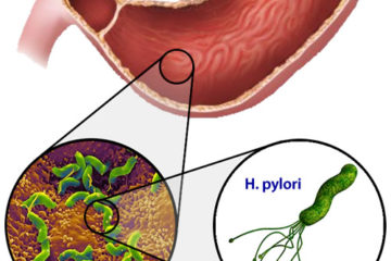Điều trị và phòng ngừa Loét dạ dày tá tràng do H. pylori