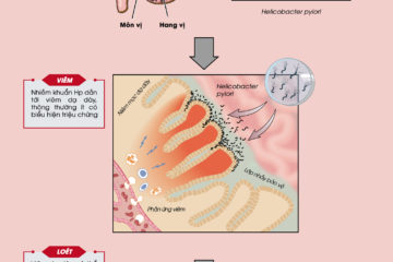 Infographic – Vi khuẩn Helicobacter Pylori – Nguyên nhân gây viêm loét dạ dày
