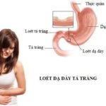 Bệnh viêm loét dạ dày tá tràng ở trẻ em cần điều trị sớm Bệnh viêm loét dạ dày tá tràng ở trẻ em cần điều trị sớm