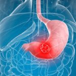 Diệt Hp sớm để phòng ngừa ung thư dạ dày