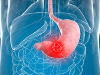 Diệt Hp sớm để phòng ngừa ung thư dạ dày