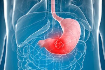 Diệt Hp sớm để phòng ngừa ung thư dạ dày