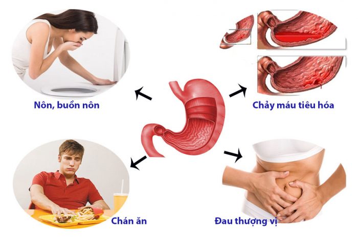 Ăn mặn dễ gây các bệnh về dạ dày
