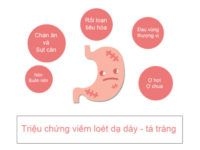 Đau dạ dày sau sinh: Bệnh dễ mắc nhưng khó lành