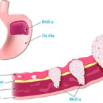 Tầm soát ung thư dạ dày là cực kì cần thiết để phát hiện sớm bệnh Tầm soát ung thư dạ dày là cực kì cần thiết để phát hiện sớm bệnh